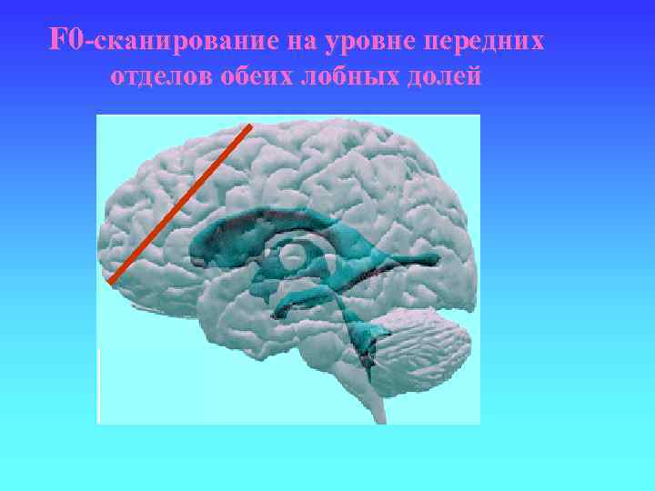 F 0 -сканирование на уровне передних отделов обеих лобных долей 