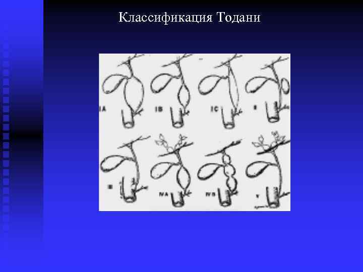 Классификация Тодани 