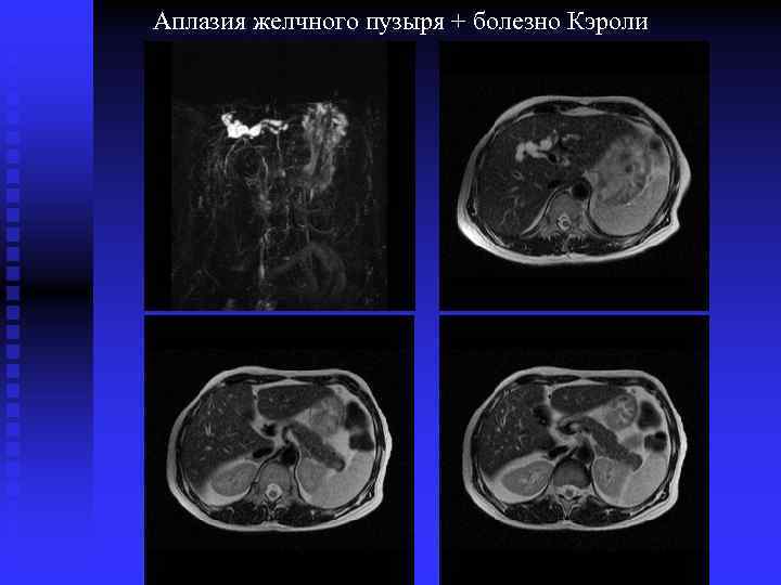 Аплазия это в медицине. Аплазия желчного пузыря. Аномалии развития желчного пузыря кт.