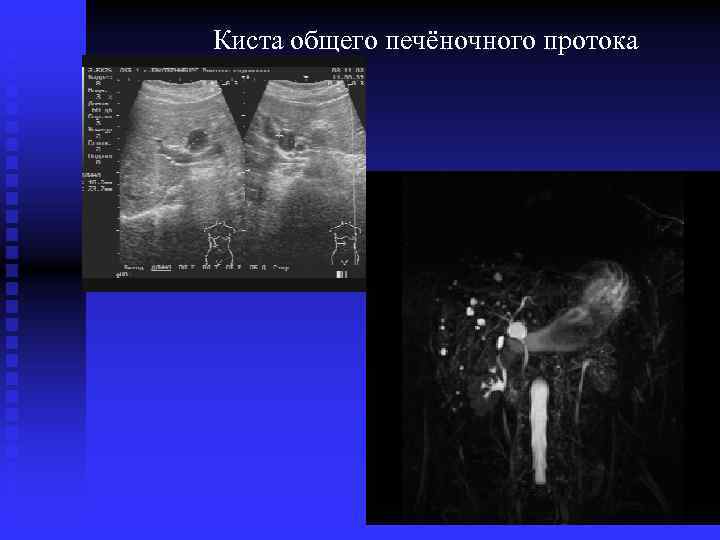 Киста общего печёночного протока 