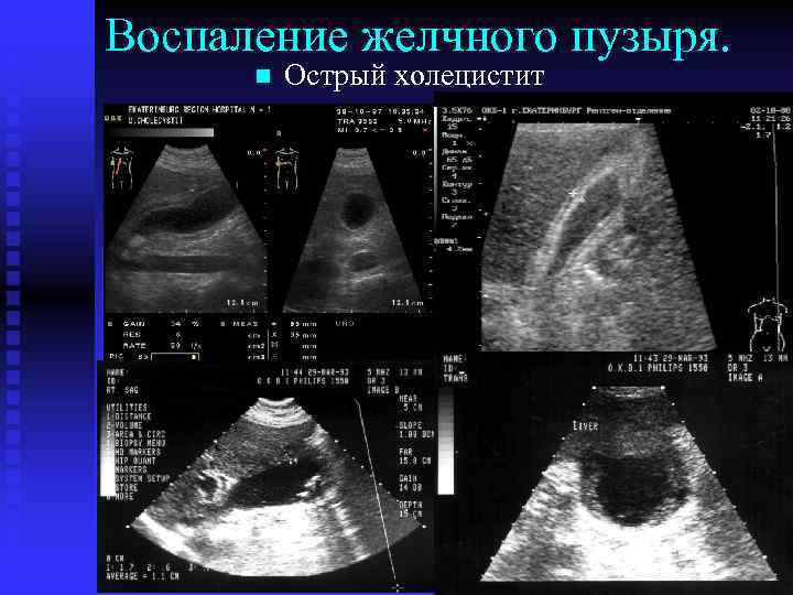 Воспаление желчного пузыря. n Острый холецистит 