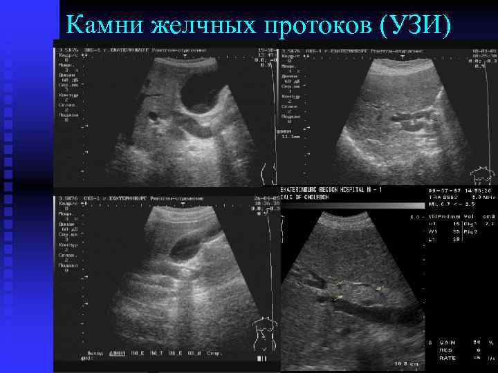 Камни желчных протоков (УЗИ) 