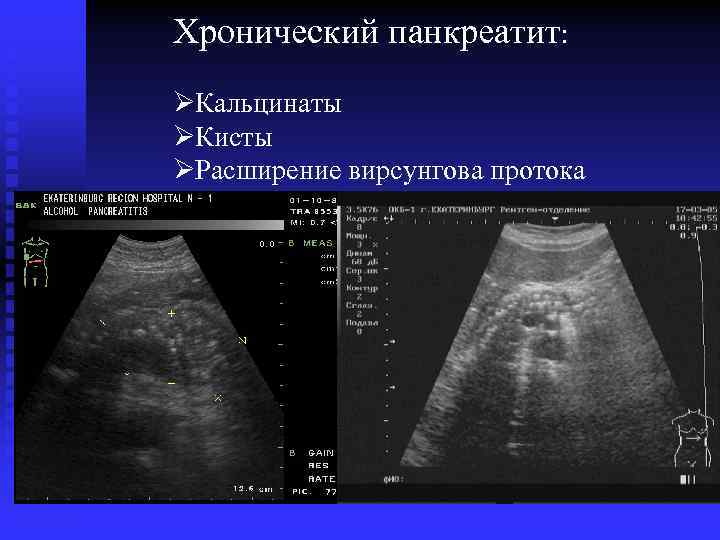 Хронический панкреатит: ØКальцинаты ØКисты ØРасширение вирсунгова протока 