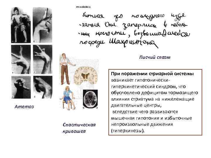 Писчий спазм Атетоз Спастическая кривошея При поражении стриарной системы возникает гипотоническигиперкинетический синдром, что обусловлено