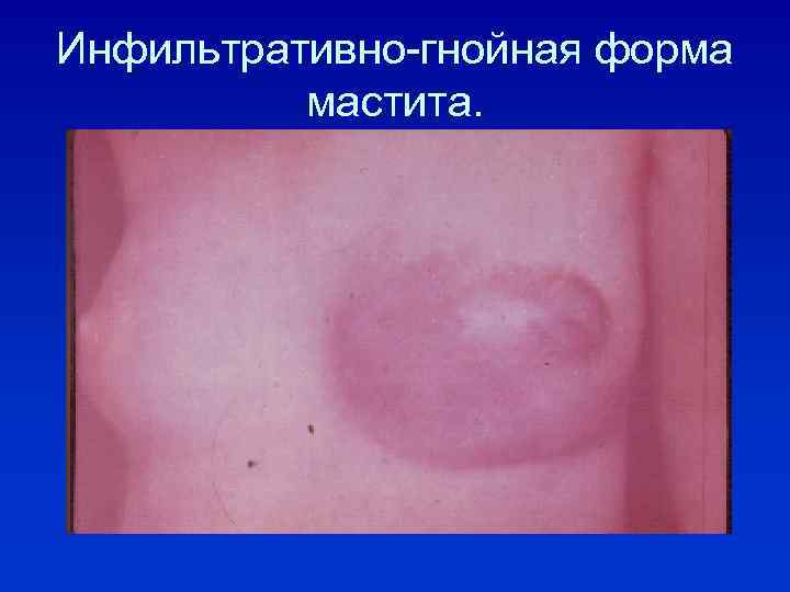 Инфильтративно-гнойная форма мастита. 