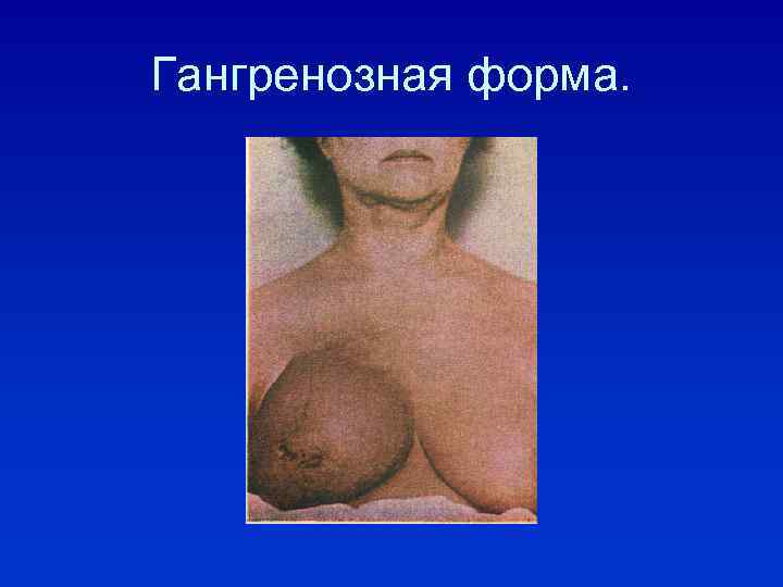 Гангренозная форма. 