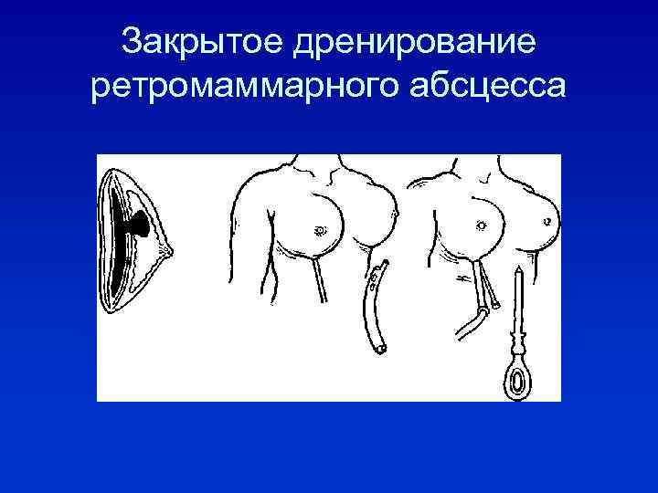 Закрытое дренирование ретромаммарного абсцесса 