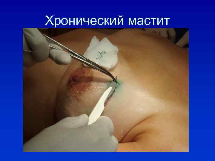 Хронический мастит 
