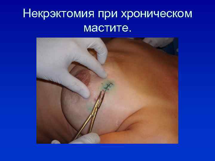 Некрэктомия при хроническом мастите. 