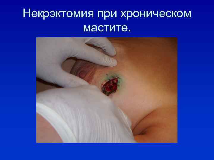 Некрэктомия при хроническом мастите. 