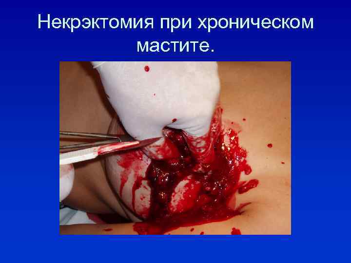 Некрэктомия при хроническом мастите. 