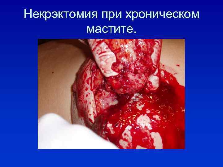 Некрэктомия при хроническом мастите. 