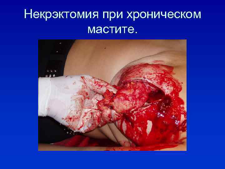 Некрэктомия при хроническом мастите. 