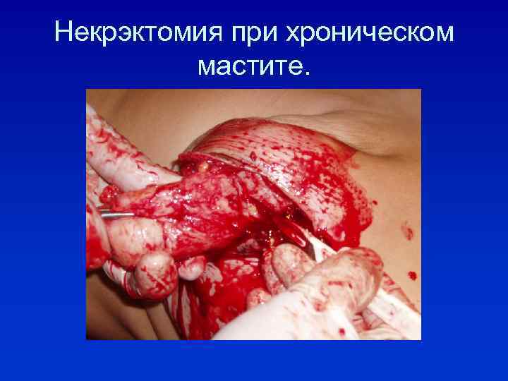 Некрэктомия при хроническом мастите. 