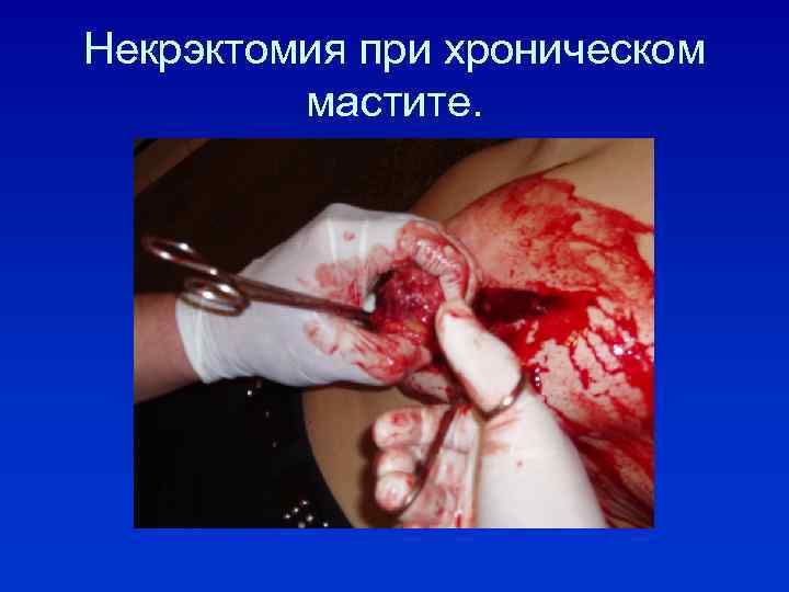 Некрэктомия при хроническом мастите. 