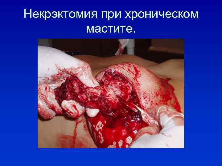 Некрэктомия при хроническом мастите. 
