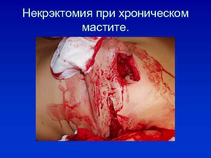 Некрэктомия при хроническом мастите. 