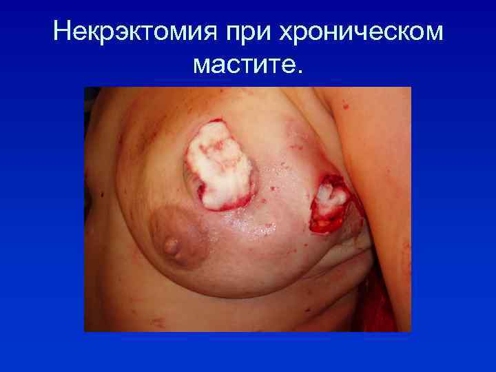 Некрэктомия при хроническом мастите. 