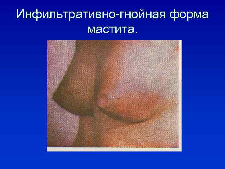 Инфильтративно-гнойная форма мастита. 