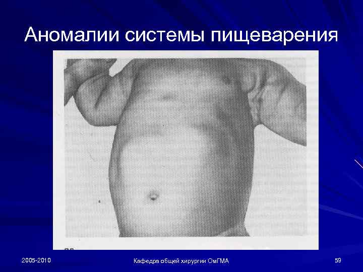 Аномалии системы пищеварения 2005 -2010 Кафедра общей хирургии Ом. ГМА 59 