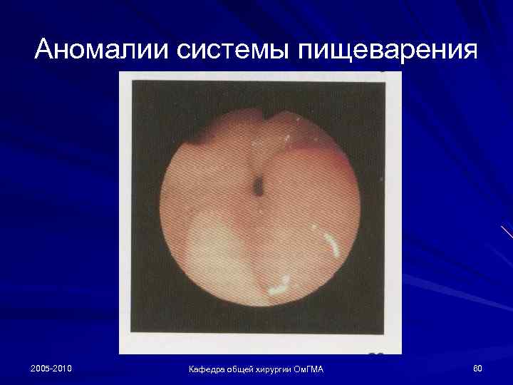 Аномалии системы пищеварения 2005 -2010 Кафедра общей хирургии Ом. ГМА 60 