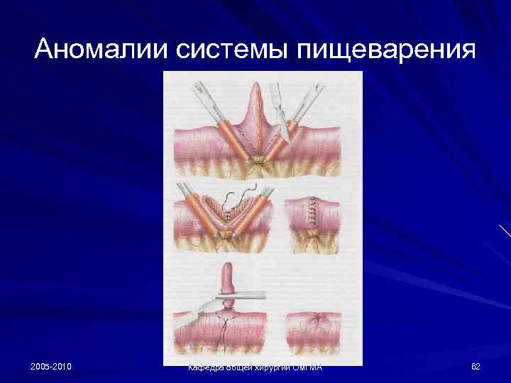 Аномалии системы пищеварения 2005 -2010 Кафедра общей хирургии Ом. ГМА 62 