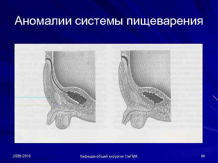 Аномалии системы пищеварения 2005 -2010 Кафедра общей хирургии Ом. ГМА 64 