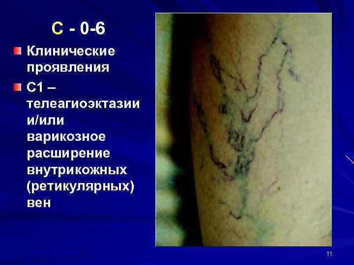 C - 0 -6 Клинические проявления С 1 – телеагиоэктазии и/или варикозное расширение внутрикожных