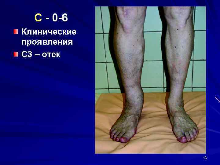 C - 0 -6 Клинические проявления С 3 – отек 13 