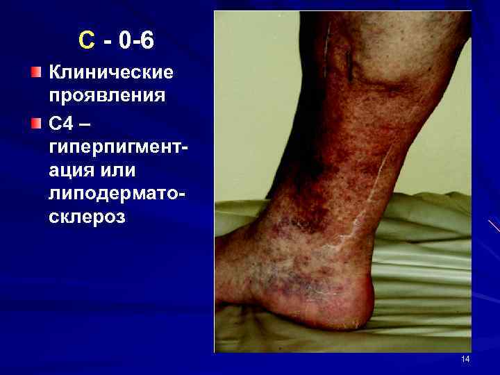 C - 0 -6 Клинические проявления С 4 – гиперпигментация или липодерматосклероз 14 