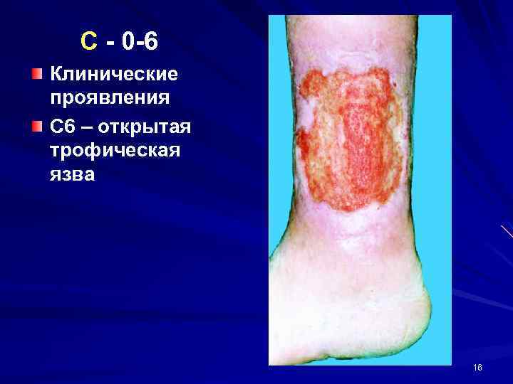 C - 0 -6 Клинические проявления С 6 – открытая трофическая язва 16 
