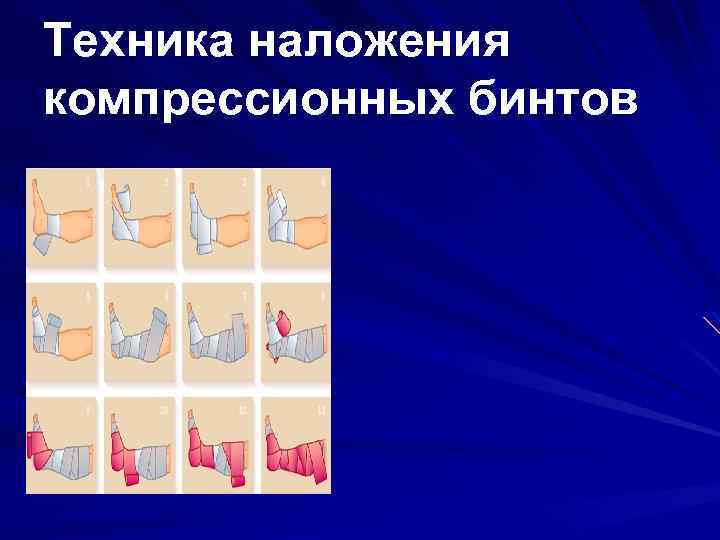 Техника наложения компрессионных бинтов 