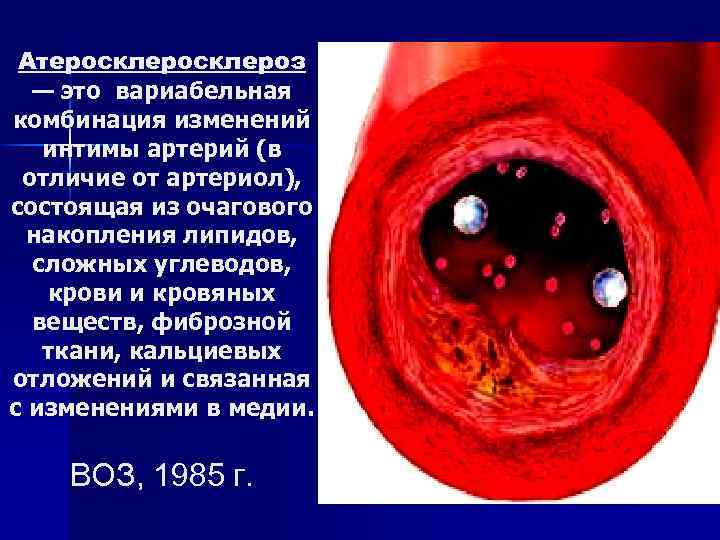 Атеросклероз — это вариабельная комбинация изменений интимы артерий (в отличие от артериол), состоящая из