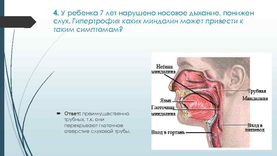 4. У ребенка 7 лет нарушено носовое дыхание, понижен слух. Гипертрофия каких миндалин может