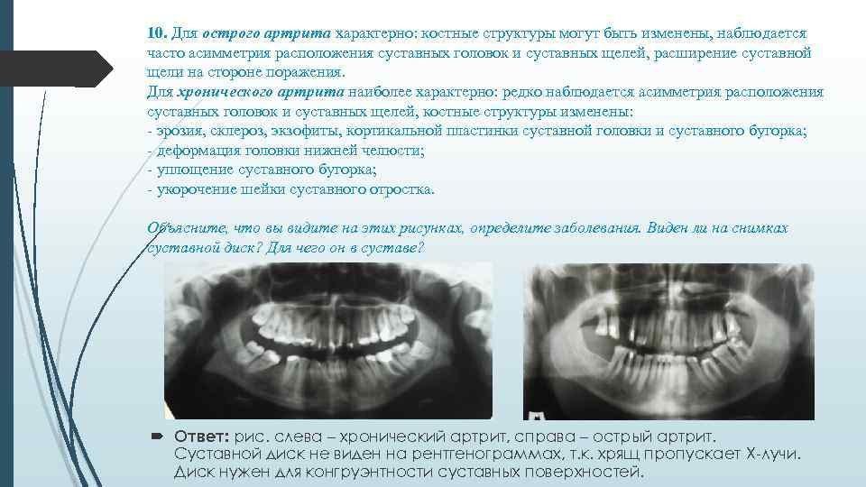 10. Для острого артрита характерно: костные структуры могут быть изменены, наблюдается часто асимметрия расположения
