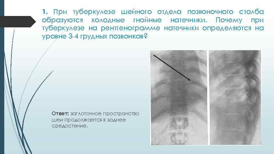 1. При туберкулезе шейного отдела позвоночного столба образуются холодные гнойные натечники. Почему при туберкулезе