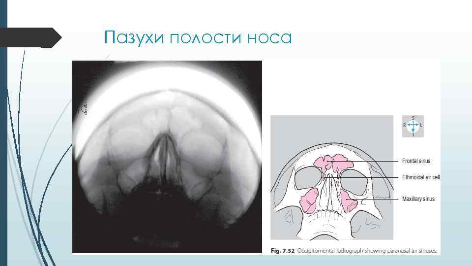 Пазухи полости носа 