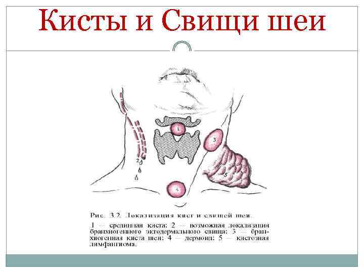 Кисты и Свищи шеи 