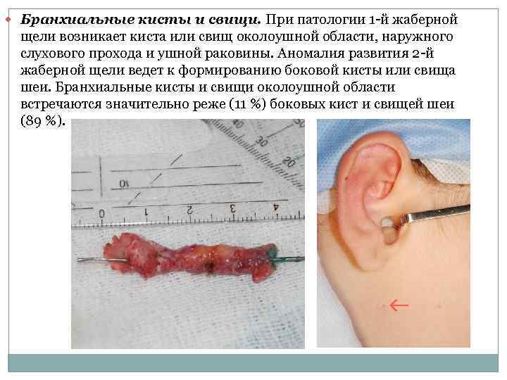  Бранхиальные кисты и свищи. При патологии 1 -й жаберной щели возникает киста или