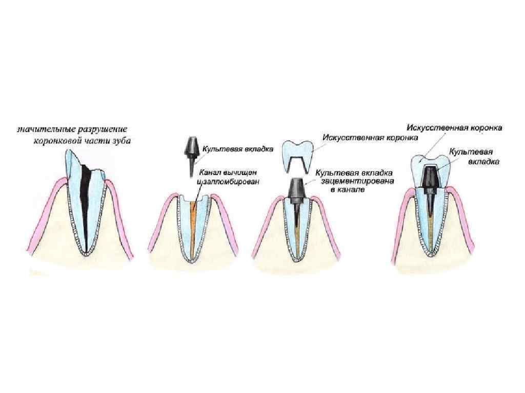 Культевая вкладка зуба. Штифтово культевая вкладка в зубе. Культевая вкладка на корень под коронку. Штифтовая культевая вкладка схема. Культевая вкладка схема установки.