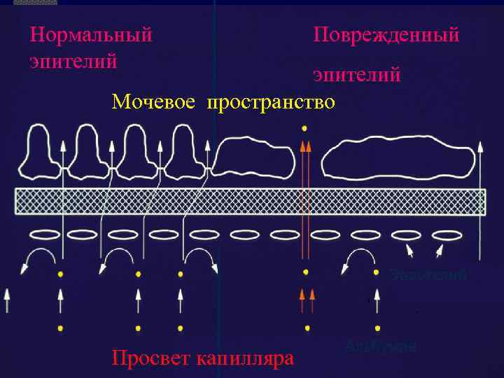 Нормальный эпителий Поврежденный эпителий Мочевое пространство Эндотелий Просвет капилляра Альбумин 