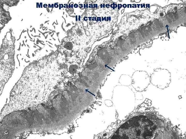 Мембранозная нефропатия II стадия * * * 