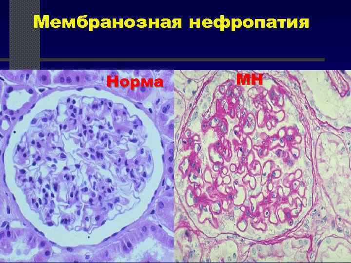 Мембранозная нефропатия Норма МН 