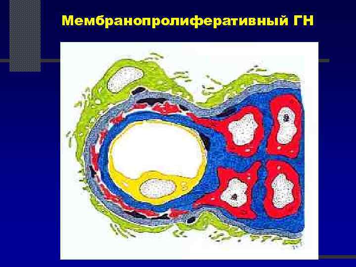 Мембранопролиферативный ГН 