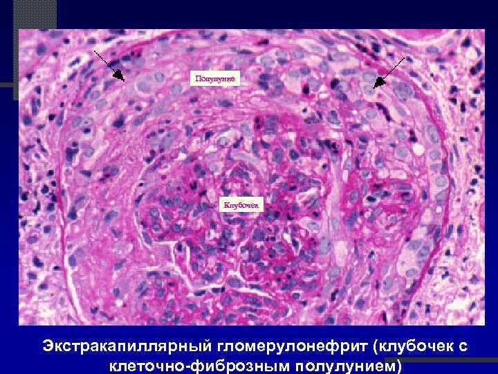 Полулуние Клубочек Экстракапиллярный гломерулонефрит (клубочек с клеточно-фиброзным полулунием) 