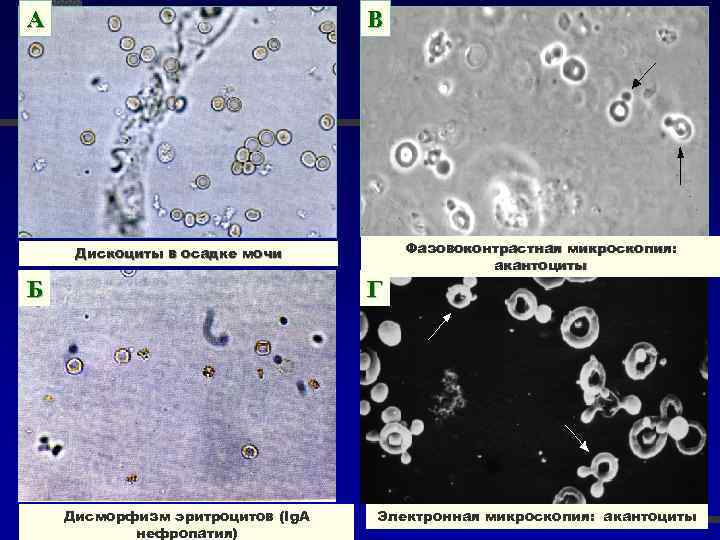 А В Фазовоконтрастная микроскопия: акантоциты Дискоциты в осадке мочи Б Г Дисморфизм эритроцитов (Ig.