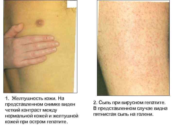 1. Желтушность кожи. На представленном снимке виден четкий контраст между нормальной кожей и желтушной