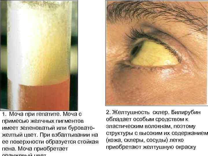 1. Моча при гепатите. Моча с примесью желчных пигментов имеет зеленоватый или буроватожелтый цвет.