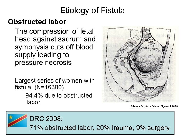 Etiology of Fistula Obstructed labor The compression of fetal head against sacrum and symphysis