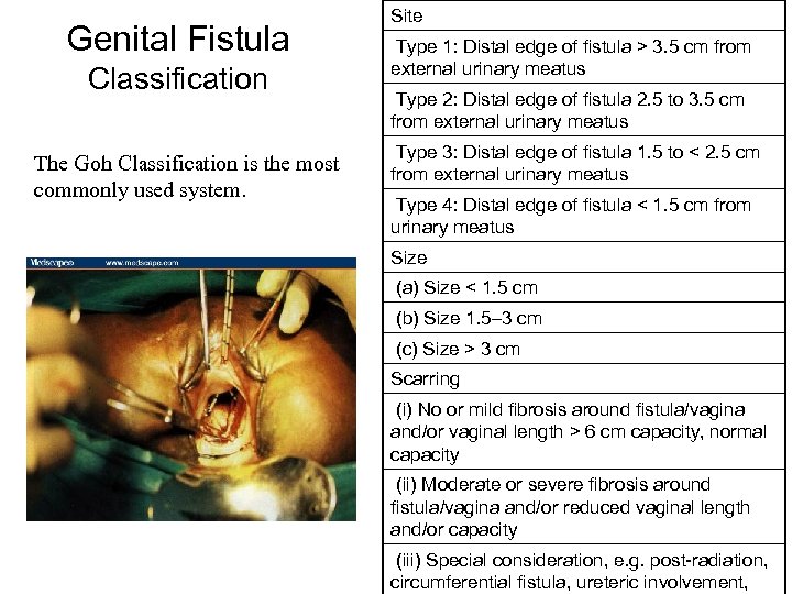 Genital Fistula Classification The Goh Classification is the most commonly used system. Site Type